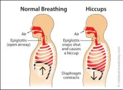 What Causes Hiccups? Fun Facts for Kids